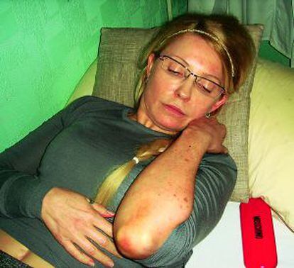 Yulia Timoshenko muestra heridas en un brazo tras denunciar malos tratos en prisión, el 25 de abril de 2012.