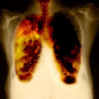 Radiografía de unos pulmones enfermos.