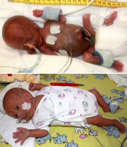 Imágenes cedidas por la Universidad Médica de Gotinga en las que puede verse al bebé en junio de 2009 (arriba) y en octubre de ese mismo año (abajo).