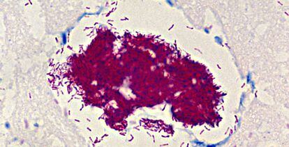 Imagen al microscopio de la bacteria que produce la úlcera de Buruli.