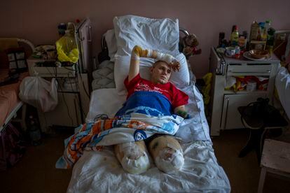 Anton Gladun, de 22 años, yace en su cama en el Third City Hospital, en Cherkasi, Ucrania, el jueves 5 de mayo de 2022. Anton, un médico militar desplegado en el frente del este de Ucrania, perdió ambas piernas y el brazo izquierdo debido a explosión de una mina el 27 de marzo. 