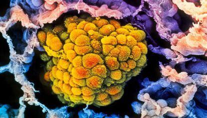 Imagen de un tumor de pulmón visto a través de microscopio electrónico.