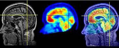 La combinación de técnicas de neuroimagen, como resonancia magnética y tomografía por emisión de positrones, permite un diagnóstico más fiable de los procesos neurodegenerativos.