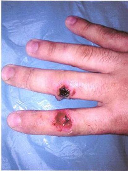 Aspecto de la mano derecha de Jordi García horas después de someterse a un tratamiento para eliminar verrugas en un ambulatorio de El Prat de Llobregat.