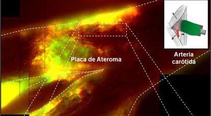 Imagen de alta resolución de la placa de ateroma en la arteria carótida