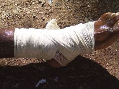 Una de las personas heridas al quedarse atrapadas en la frontera entre Melilla y Marruecos.