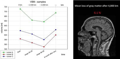 Parte del estudio presentado en el último Congreso Anual de Radiología, donde los científicos del Hospital Universitario de Ulm probaron la pérdida de masa cerebral después de una larga carrera (y su posterior recuperación).