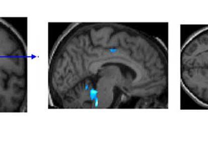 Cerebro de una persona mayor de 65 años sana. En azul, las regiones que se activan durante la labor de memorización visual. Las personas sanas con mayores reservas cognitivas activan menos regiones porque necesitan menos recursos.
Por el contrario, las personas mayores con alzhéimer o algún tipo de deterioro cognitivo que han cultivado reservas presentan una mayor activación, ya que pueden compensar las pérdidas físicas ligadas a la enfermedad.