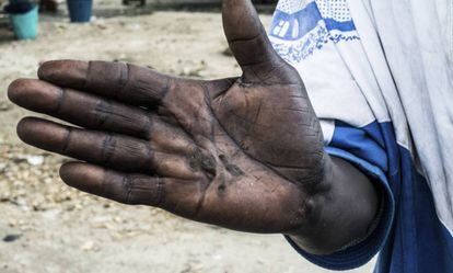 Un niño ghanés muestra los daños sufridos en la mano por ejercer la pesca.