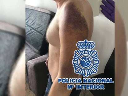Las lesiones de la presunta víctima danesa secuestrada en Marbella. / Vídeo: La Policía libera en Marbella a un presunto narco secuestrado durante diez días.