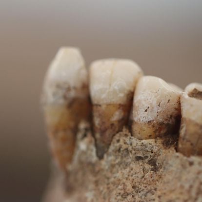En esta dentadura de hace 5.000 años recuperada en el sur de Italia se puede apreciar perfectamente el sarro con restos de decenas de especies de bacterias.