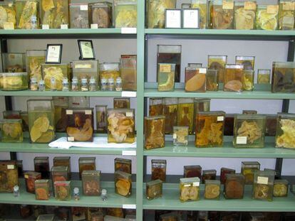 Sala con órganos enfermos en el Museo Vasco de Historia de la Medicina, en Leioa.