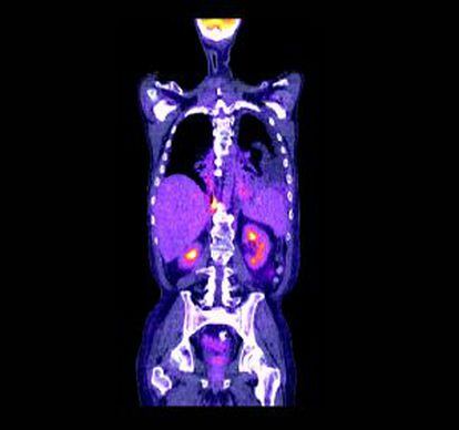 Tomografía de un cáncer de pulmón.