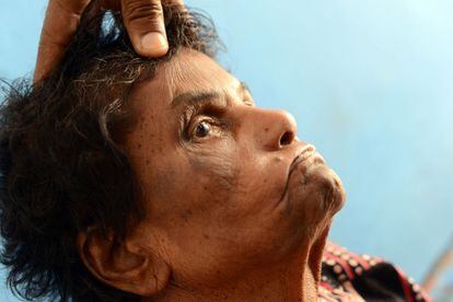 Un sanitario de Sumanahalli comprueba el estado de los ojos de una paciente de lepra. La mayoría han sido despechados por sus familias