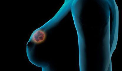 Cáncer de mama