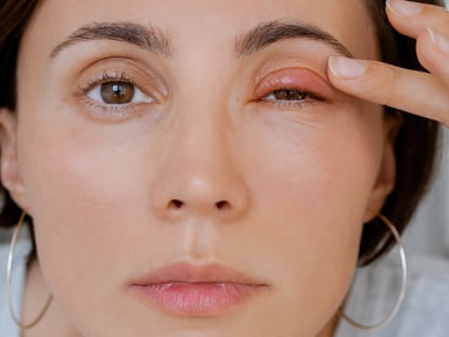 Con estos productos es posible reducir el picor e hinchazón causados por la dermatitis en párpados. GETTY IMAGES.