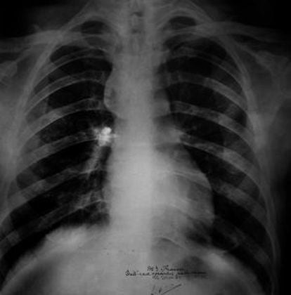 Radiografía del tórax donde se ve la bala.