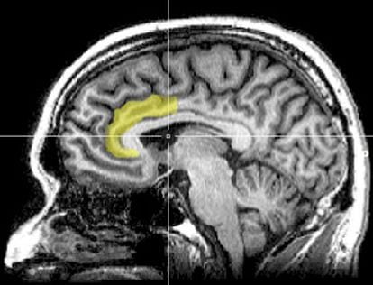 Neuroimagen sagital del cerebro humano mostrando en color amarillo la circunvolución cingulada anterior, un área que ha sido relacionada con la orientación ideológica de las personas.