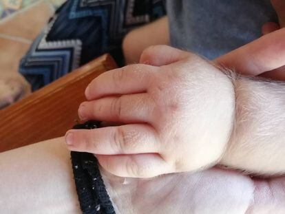 La mano de un bebé afectado por el síndrome del hombre lobo.