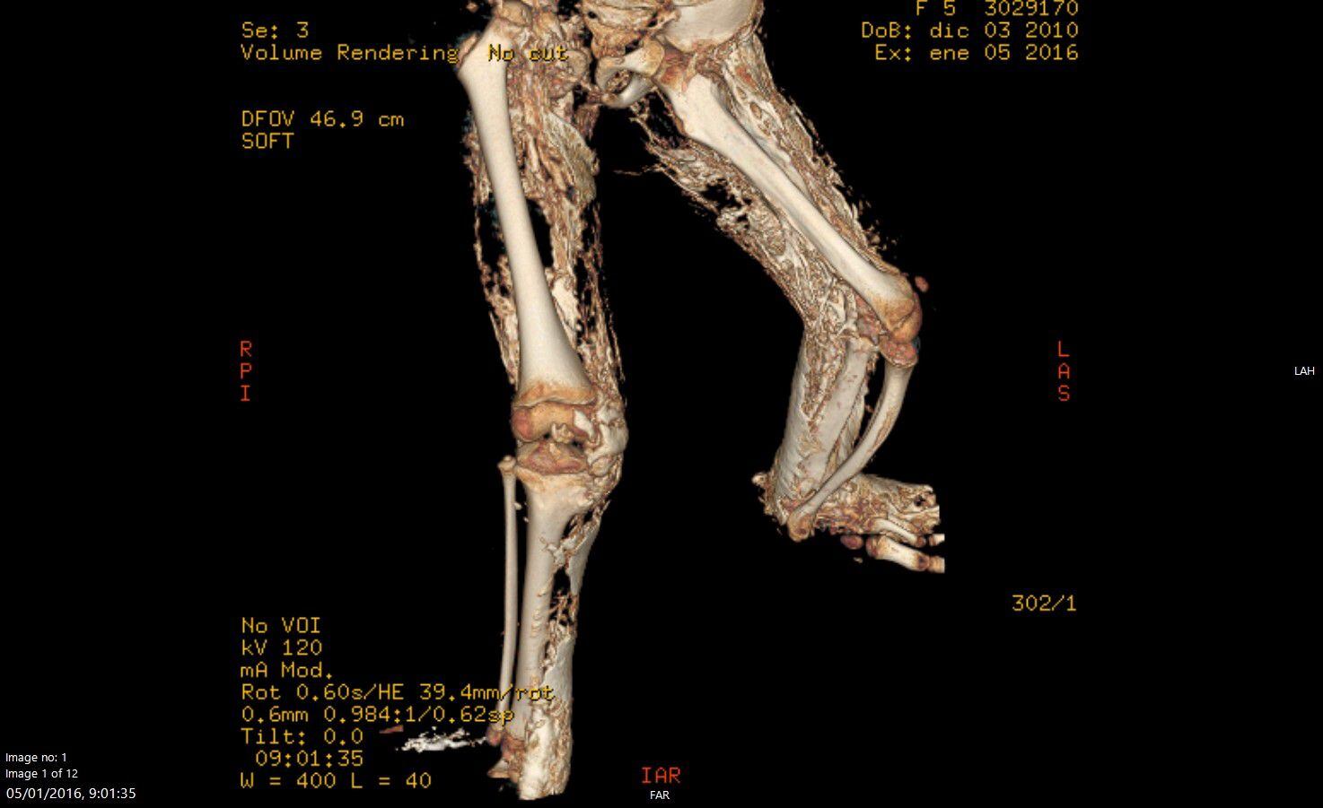 Escáner de las piernas de Cayetana en 2016, en el que se aprecia la transformación de músculo en hueso.