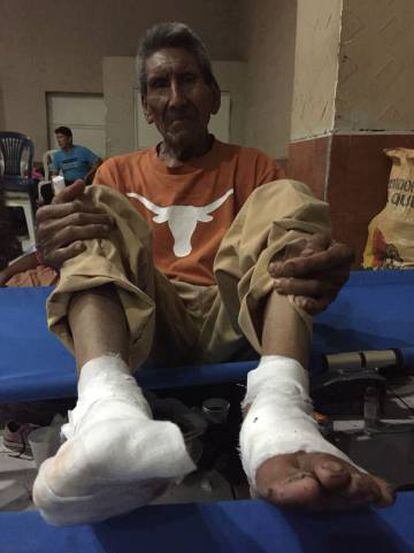 Domingo Lopez (79), con los pies quemados por la lava.