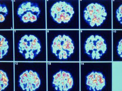 Deterioro de distintas partes del cerebro causado por el alzh&egrave;imer