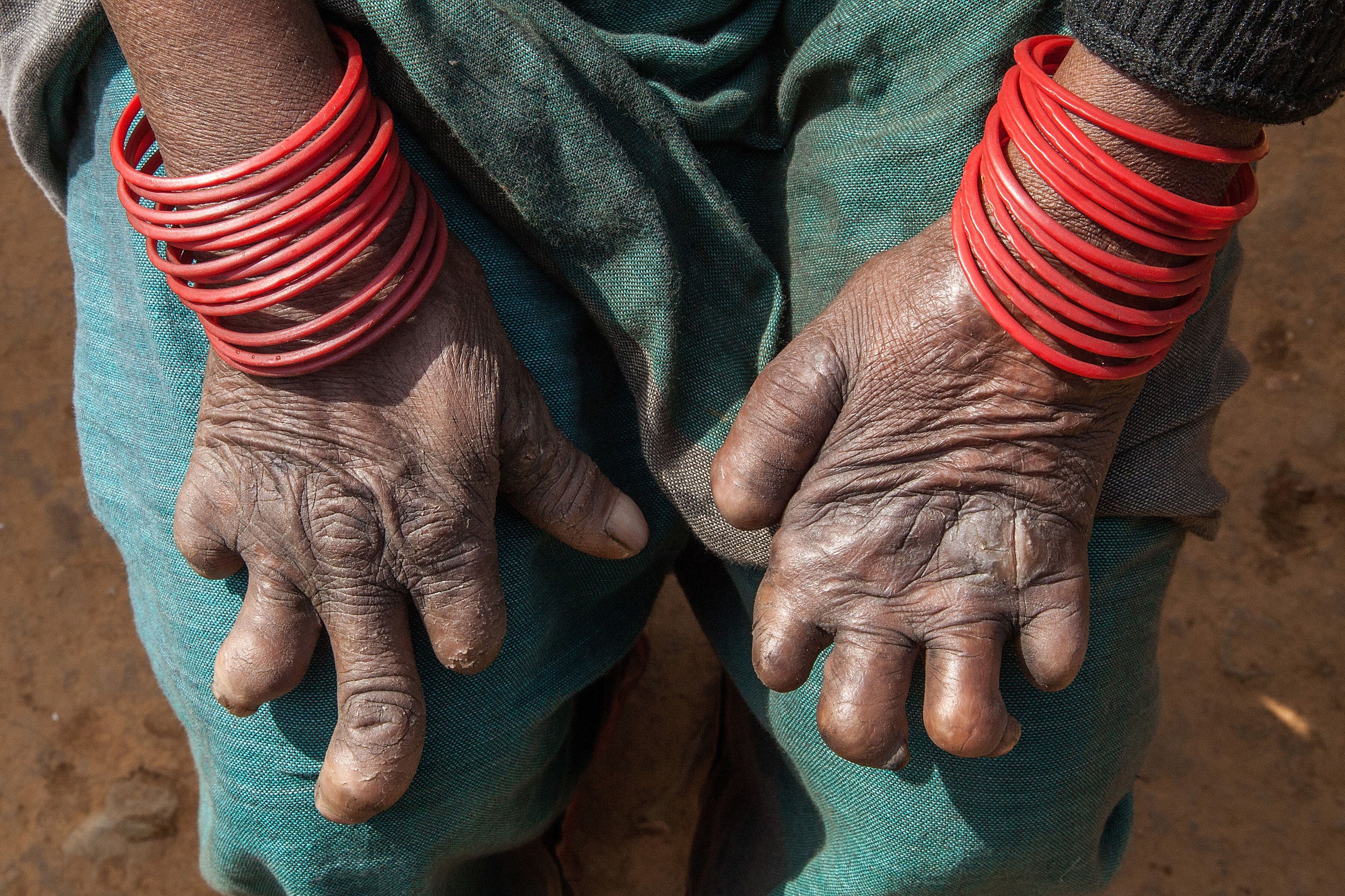 Una mujer afectada por lepra muestra sus manos en el hospital Leprosy Mission de Nepal, uno de los países donde existen aún leyes discriminatorias contra personas que han padecido o padecen esta enfermedad. 