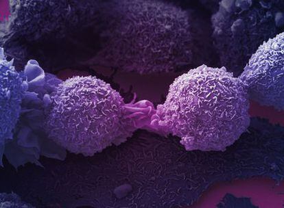 Células de cáncer de pulmón al microscopio.