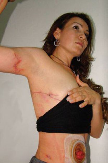 La exalcaldesa de Tiquicheo muestra sus heridas tras sufrir un atentado en 2010.