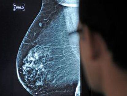 Un m&eacute;dico observa una mamograf&iacute;a en el hospital Virgen del Roc&iacute;o de Sevilla. 