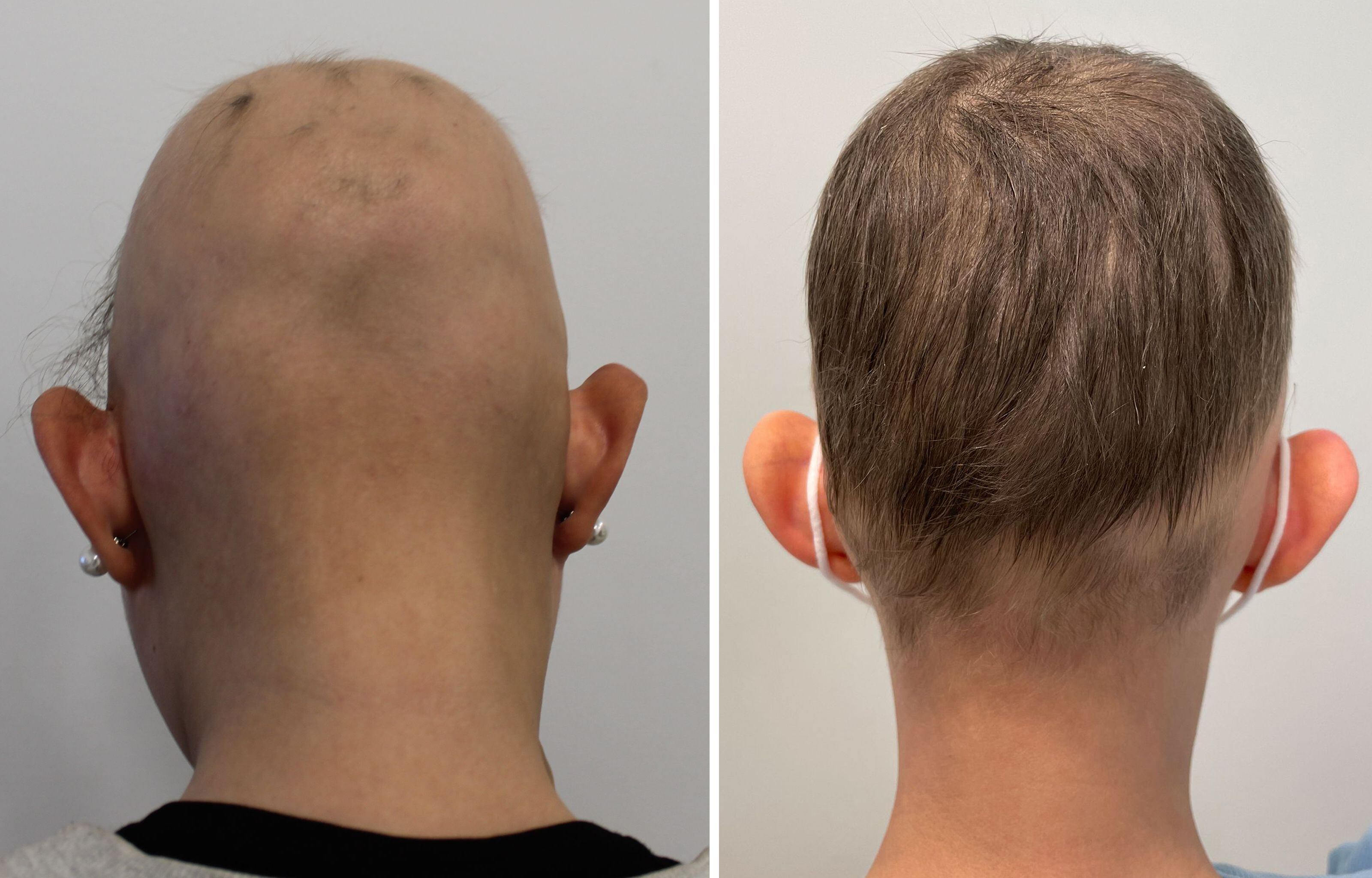 La joven María Guaita, paciente con alopeacia areata, antes y después de tomar el fármaco baricitinib. Imágenes facilitadas por el dermatólogo Sergio Vañó.