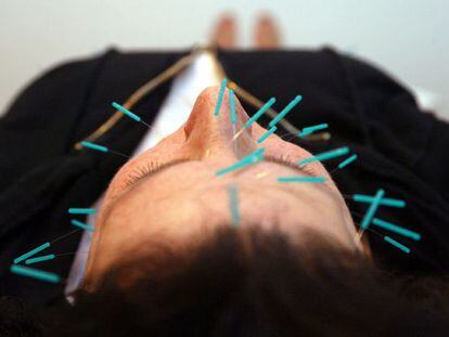 Una mujer durante una sesión de acupuntura.