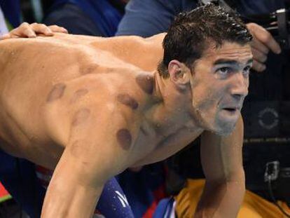 El nadador luce unas marcas moradas producto de una terapia llamada  cupping 