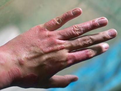 Un paciente con psoriasis en la mano.