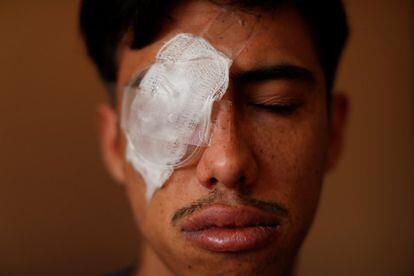 Jean Espinoza, de 22 años, recibió un impacto en el ojo con un perdigón mientras protestaba en Iquique, Chile.