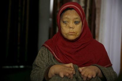 Una paciente con lepra es fotografiada en su habitación en el hospital de Srinagar (India) donde se trata a este tipo de pacientes.