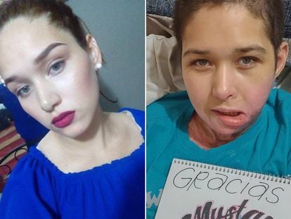 A la izquierda, Liliana Torres en marzo de 2021. A la derecha, la joven después del ataque, en junio de 2022.