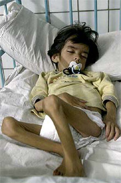Un niño con síntomas de desnutrición, ingresado en el hospital de Tucuman.