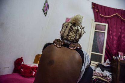 La joven etíope Meriem muestra las marcas de los golpes que le asestaron sus empleadores libaneses, en una casa de acogida en Beirut.