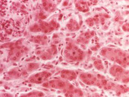 Tejido hepático de una persona con hepatitis.