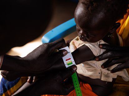 Examen médico de una niña en búsqueda de síntomas de desnutrición, en el asentamiento de refugiados de Rotriak (Sudán del Sur)