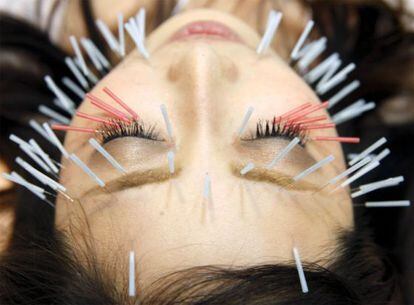 La acupuntura es eficaz para tratar náuseas y cefaleas.
