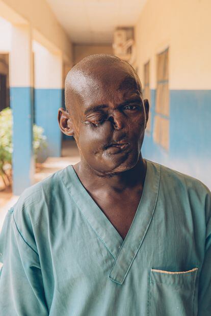 Dahiru Saidu, de 32 años, fue paciente del Hospital Noma en Sokoto, Nigeria. Para ganarse la vida, tiene tres trabajos diferentes: agricultor en las afueras de Sokoto, lavacoches y limpiador en el hospital.