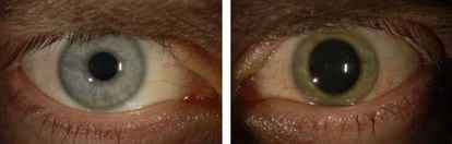 Antes de contraer el ébola, los ojos de Crozier eran azules. Después de haberse recuperado de la enfermedad, su ojo izquierdo se volvió verde.