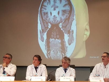 Els doctors Rodrigo Rocamora, Gerard Conesa, Julio Pascual i Jaume Capellades en la presentació de l'ablació làser.