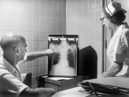 Un médico y una enfermera examinan una radiografía de tórax positiva para tuberculosis en el año 1958.