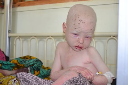 Moses, un niño con albinismo, sentado en una cama de la unidad de pediatría del Hospital Central de Kamuzu, en Lilongüe, Malawi. Llegó aquejado de una enfermedad en la piel.