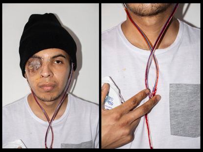 22/05/21 Jóvenes heridos en las protestas de Colombia. En la foto, Juan Fonseca, que ha perdido un ojo. FOTO: CAMILO ROZO
