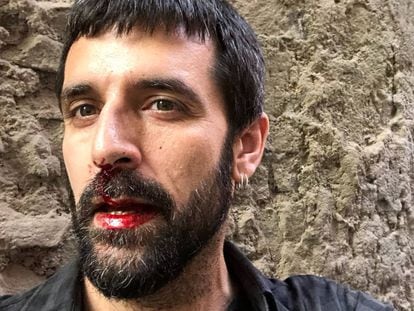 Jordi Borràs, poco después de la agresión.