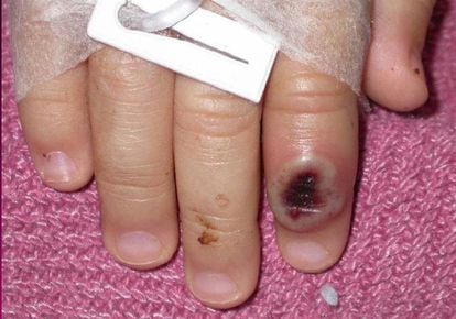 Lesión causada por la viruela del mono en la mano de un niño.